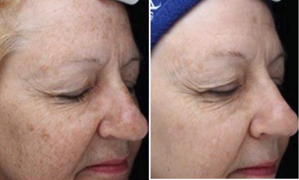 before and after BBL HEROic laser photofacial