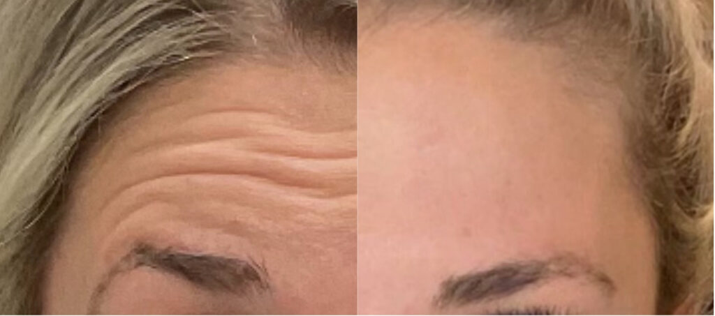 forehead wrinkles before and after Botox 