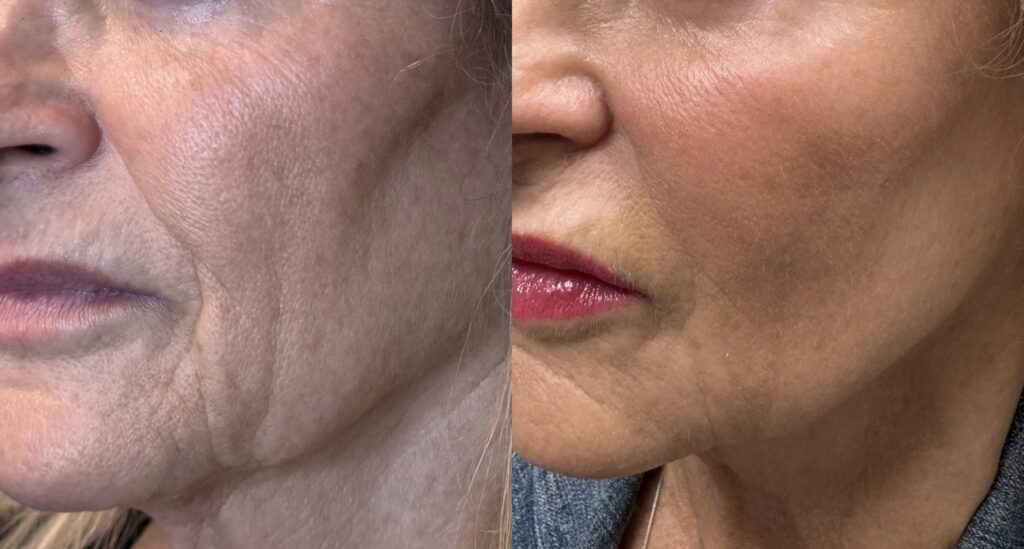 before and after dermal fillers to cheek and jowls