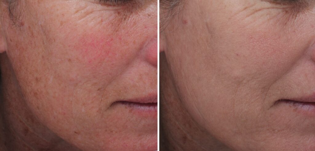 before and after Moxi laser skin resurfacing