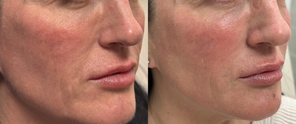 skin hydration before and after skinvive